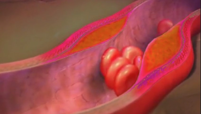 inflammation