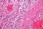 nodules