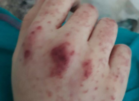 Julie - cagnotte pour la vascularite à IgA (Purpura rhumatoïde) - maladie rare auto-immune